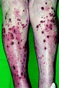 Image result for Excoriation Skin Lesion