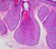 Image result for Molluscum STD