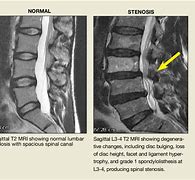 Image result for MRI Lumbar Spine Stenosis