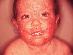 Image result for Toddler Skin Rash