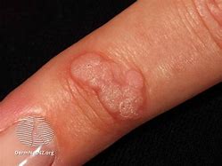 Image result for Viral Warts Condyloma