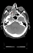 Image result for Nasal Mucosal Melanoma