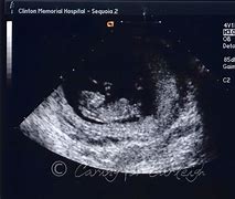 Image result for Anencephaly On 12 Week Ultrasound