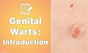 Image result for Genital Wart