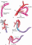 Image result for Addrom Bypass