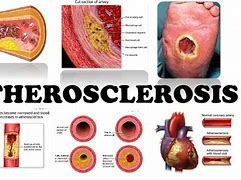 Image result for aterosclerosis