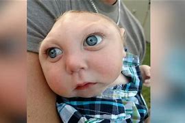 Image result for Baby Born with No Skull
