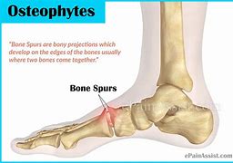 Image result for Private Bone Spurs
