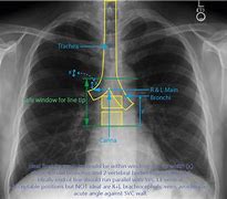 Image result for PICC Line Picture End Tip