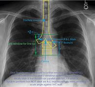 Image result for PICC Line Catheter Tip