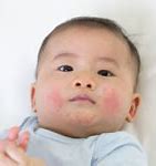 Image result for Eczema