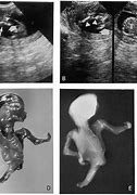 Image result for Sirenomelia Ultrasound