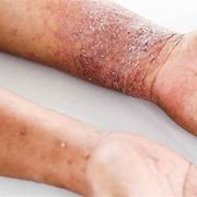 Image result for Atopic Dermatitis Images