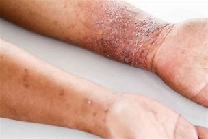 Image result for Eczema On Back