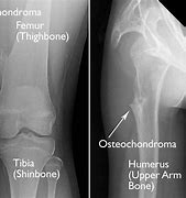 Image result for Types of Chondroma