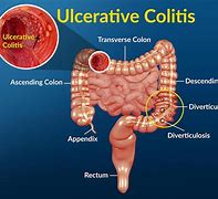 Image result for colitis
