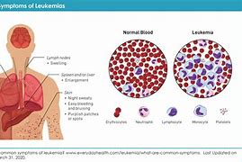 Image result for Chronic Myeloid Leukemia Symptoms