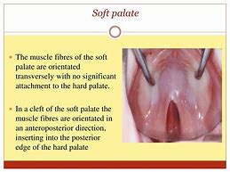 Image result for Soft Palate Papilloma