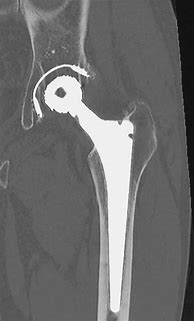 Image result for What Does a Hip Replacement Look Like