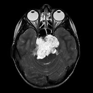 Image result for Sacral Chordoma Tumor