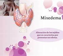 Image result for mixedema