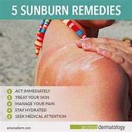 Image result for Ways to Cure Sun Burn