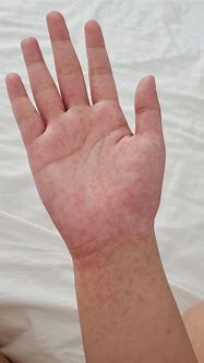 Image result for Bumpy Itchy Rash On Hands
