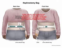 Image result for Nephrostomy Stoma Bag