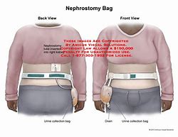Image result for Double Nephrostomy Bag Holder