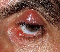Image result for Meibomian Cyst