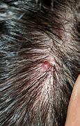 Image result for Hard Pebbles in the Scalp