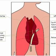 Image result for Chest Tube Suction