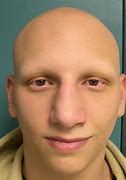 Image result for alopecua