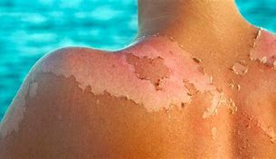 Image result for SunBurn Itchy Skin