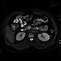 Image result for Pancreas Tumor MRI