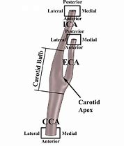 Image result for Carotid Bulb Anatomy