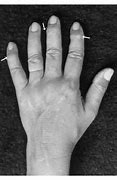 Image result for Bone Spur Knuckle Joint