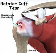 Image result for Torn Rotator Cuff Left Shoulder