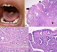 Image result for choristoma