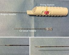 Image result for Core Needle Biopsy Procedure