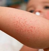 Image result for Childhood Skin Rashes