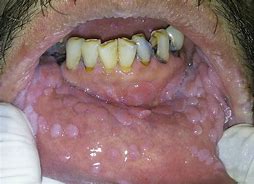 Image result for Papilloma in Throat
