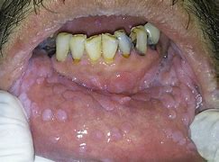 Image result for Condyloma Papillomavirus