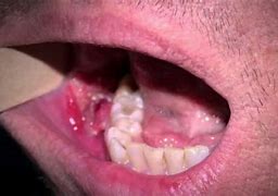 Image result for Oral Cancer