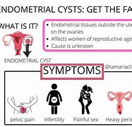 Image result for Endometriosis Cyst