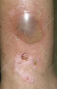 Image result for Blood Blister On Leg