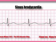 bradycardia 的图像结果