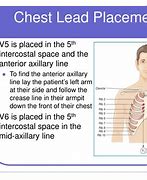 Image result for Chest Lead Placement
