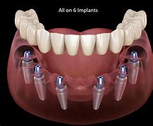 Image result for All On X Dental Implants
