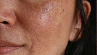 Image result for Skin Discoloration On Face